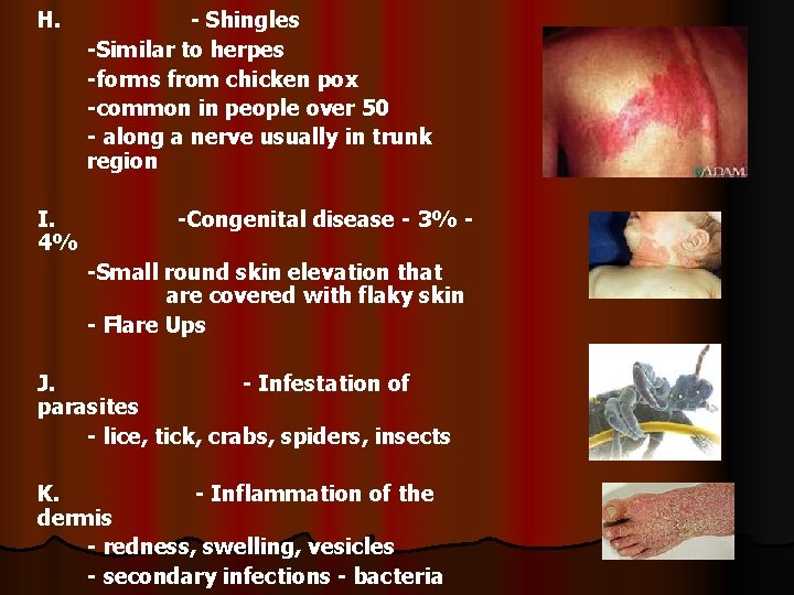 H. I. 4% - Shingles -Similar to herpes -forms from chicken pox -common in