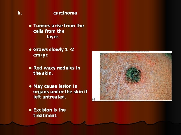 b. carcinoma l Tumors arise from the cells from the layer. l Grows slowly