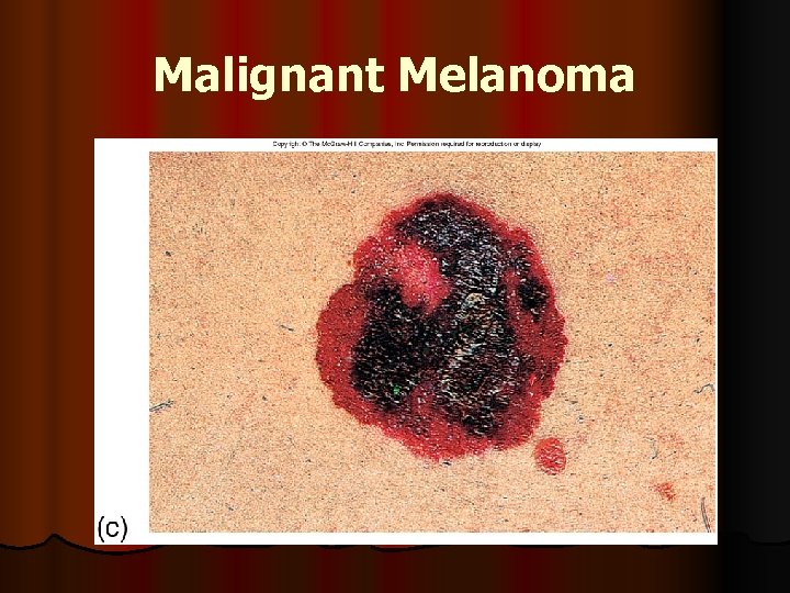 Malignant Melanoma 