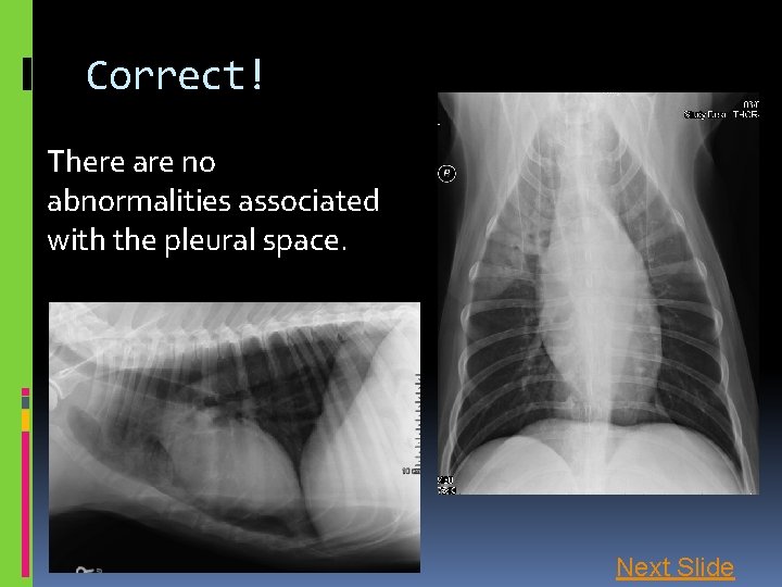 Correct! There are no abnormalities associated with the pleural space. Next Slide 