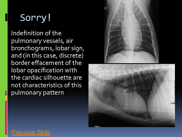 Sorry! Indefinition of the pulmonary vessels, air bronchograms, lobar sign, and (in this case,