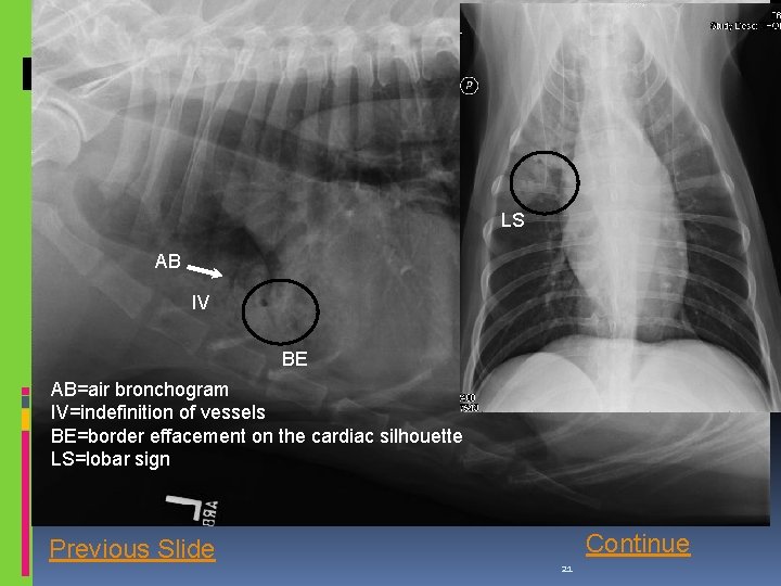LS AB IV BE AB=air bronchogram IV=indefinition of vessels BE=border effacement on the cardiac