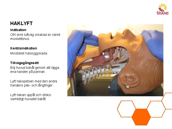 HAKLYFT Indikation Ofri övre luftväg orsakad av sänkt muskeltonus. Kontraindikation Misstänkt halsryggskada. Tillvägagångssätt Böj