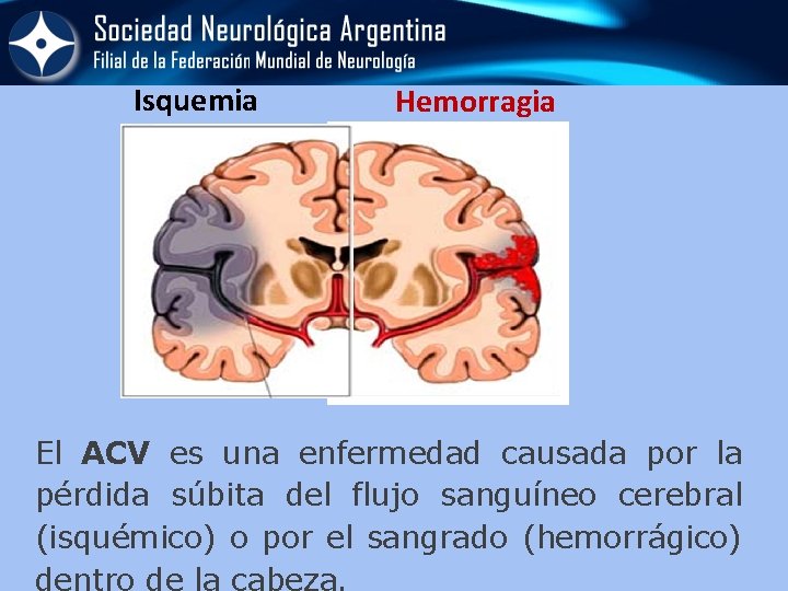 Isquemia Hemorragia El ACV es una enfermedad causada por la pérdida súbita del flujo