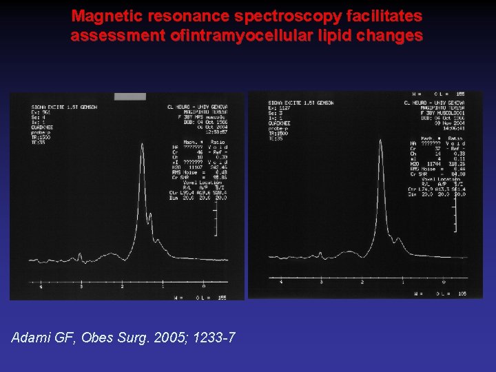 Magnetic resonance spectroscopy facilitates assessment ofintramyocellular lipid changes Adami GF, Obes Surg. 2005; 1233