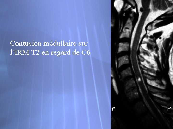 Contusion médullaire sur l’IRM T 2 en regard de C 6 