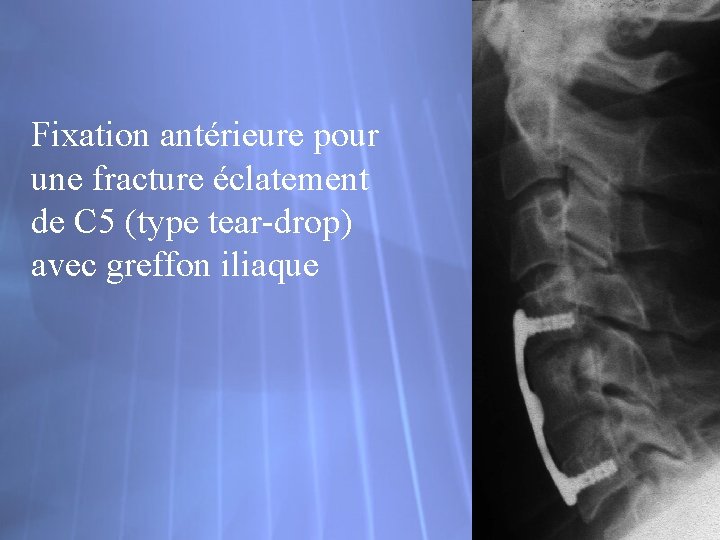 Fixation antérieure pour une fracture éclatement de C 5 (type tear-drop) avec greffon iliaque
