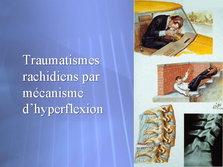 Traumatismes rachidiens par mécanisme d’hyperflexion 