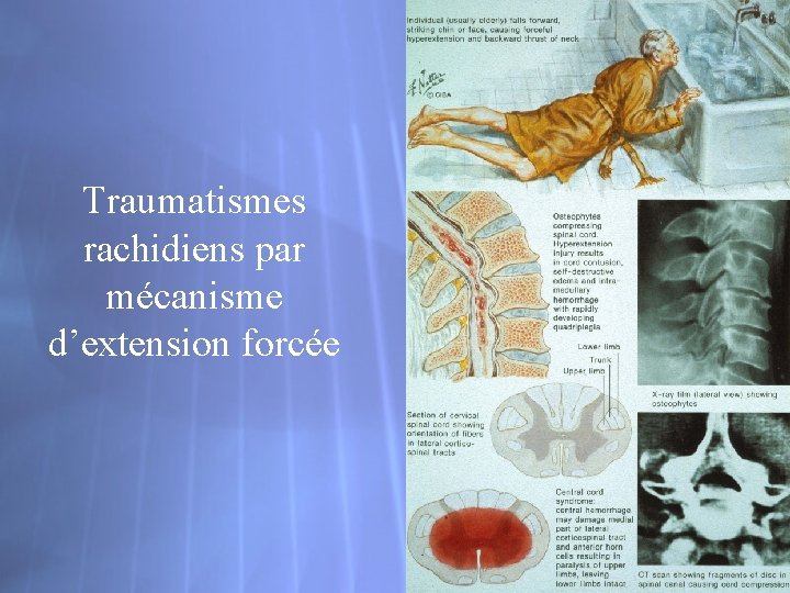 Traumatismes rachidiens par mécanisme d’extension forcée 