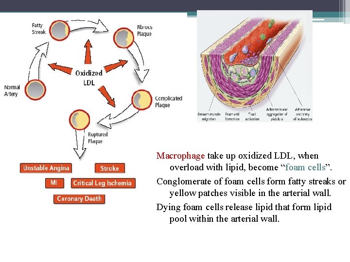 Macrophage take up oxidized LDL, when overload with lipid, become “foam cells”. Conglomerate of
