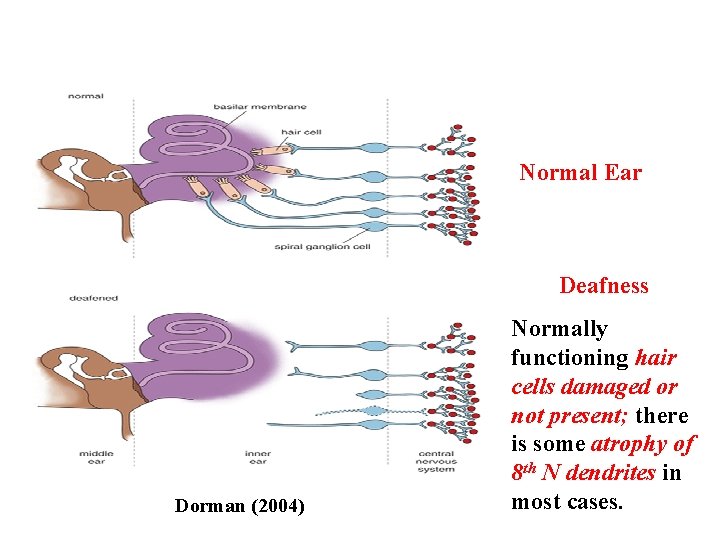 Normal Ear Deafness Dorman (2004) Normally functioning hair cells damaged or not present; there