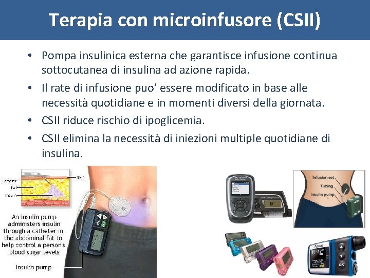Terapia con microinfusore (CSII) • Pompa insulinica esterna che garantisce infusione continua sottocutanea di