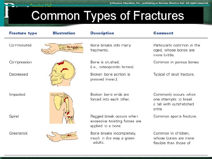 Common Types of Fractures Table 5. 2 Go to Copyright. Section: © 2003 Pearson