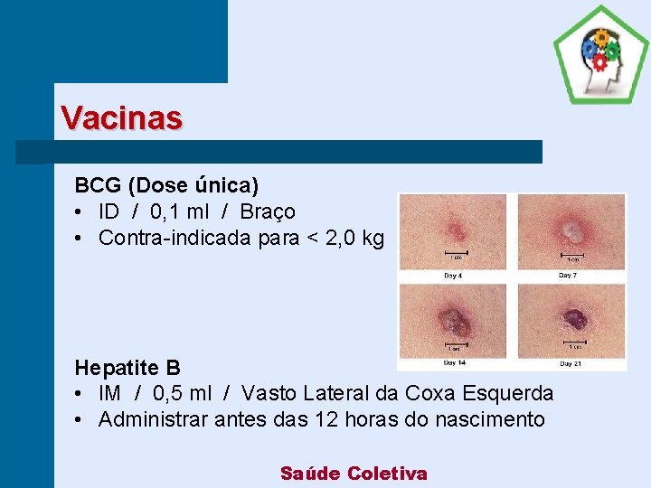 Vacinas BCG (Dose única) • ID / 0, 1 ml / Braço • Contra-indicada