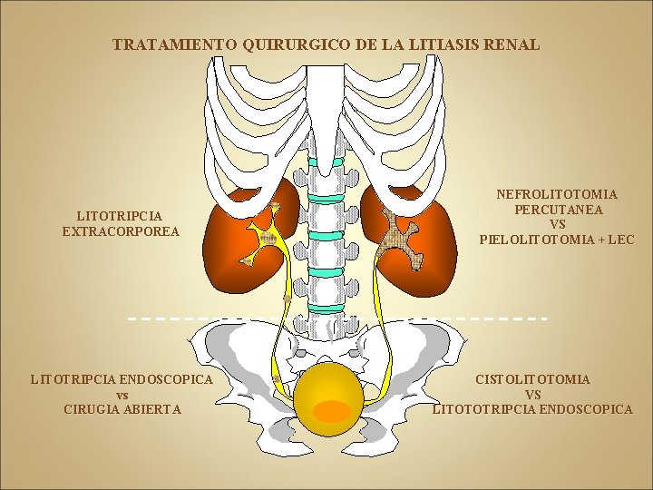 TRATAMIENTO QUIRURGICO DE LA LITIASIS RENAL LITOTRIPCIA EXTRACORPOREA LITOTRIPCIA ENDOSCOPICA vs CIRUGIA ABIERTA NEFROLITOTOMIA