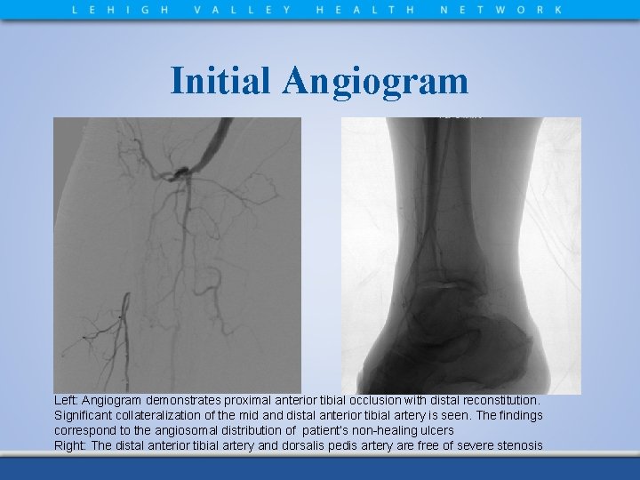Initial Angiogram Left: Angiogram demonstrates proximal anterior tibial occlusion with distal reconstitution. Significant collateralization