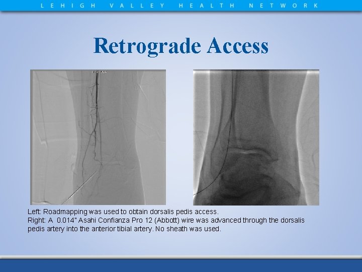 Retrograde Access Left: Roadmapping was used to obtain dorsalis pedis access. Right: A 0.