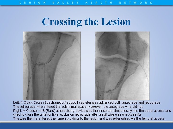 Crossing the Lesion Left: A Quick-Cross (Spectranetics) support catheter was advanced both antegrade and