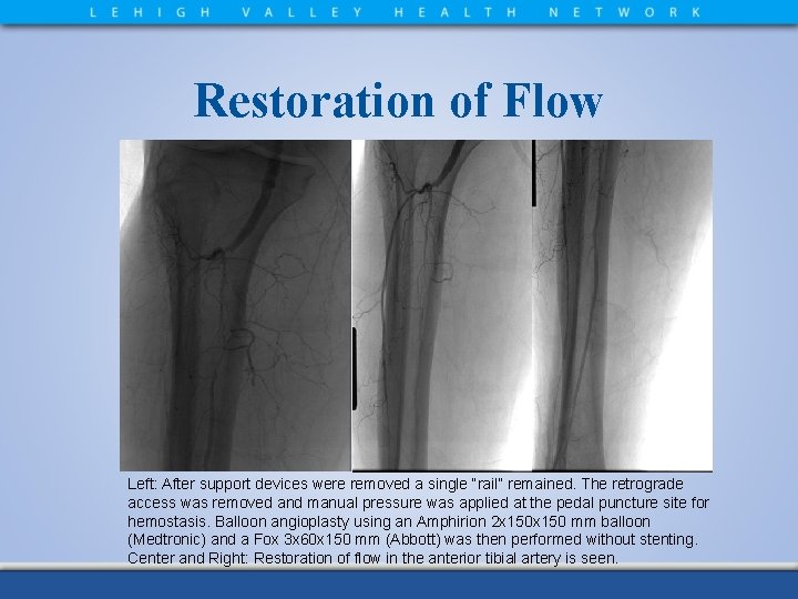 Restoration of Flow Left: After support devices were removed a single “rail” remained. The