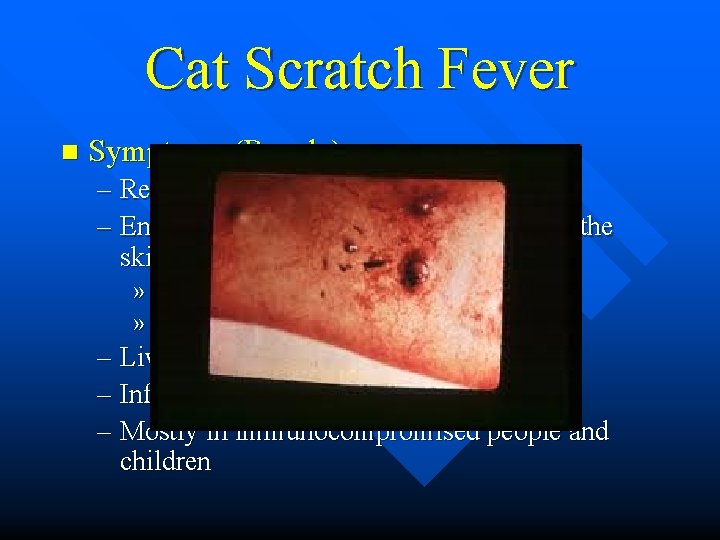 Cat Scratch Fever n Symptoms (People) – Relapsing fever – Enlarged lymph nodes, with