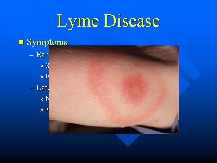 Lyme Disease n Symptoms – Early » Skin rash at the tick bite »