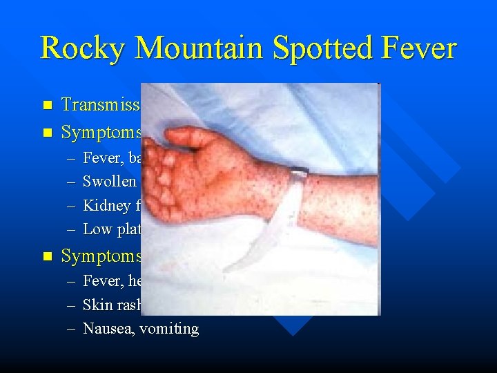 Rocky Mountain Spotted Fever n n Transmission – ticks (Dermacentor spp. ) Symptoms (dogs)