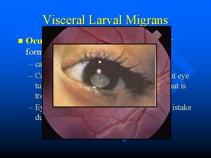 Visceral Larval Migrans n Ocular Larval Migrans is a particular form of VLM that