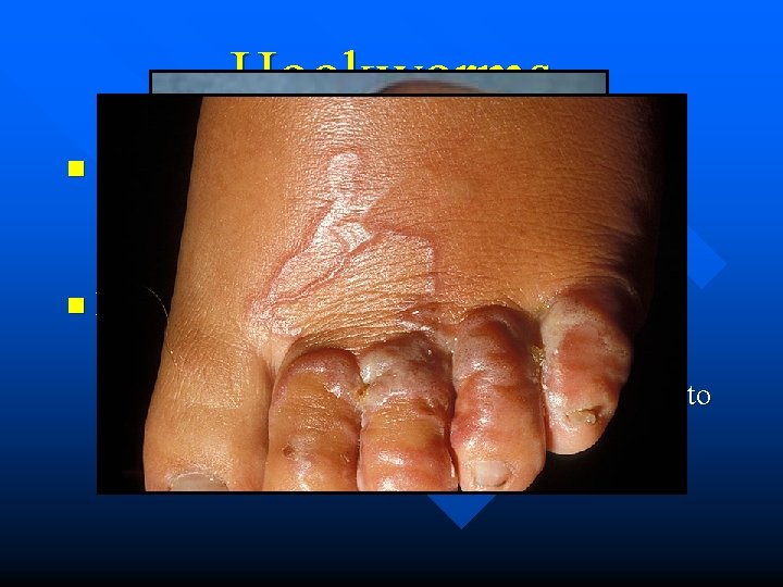Hookworms n Symptoms (people and dogs) – Cutaneous larval migrans (L 3 in skin)