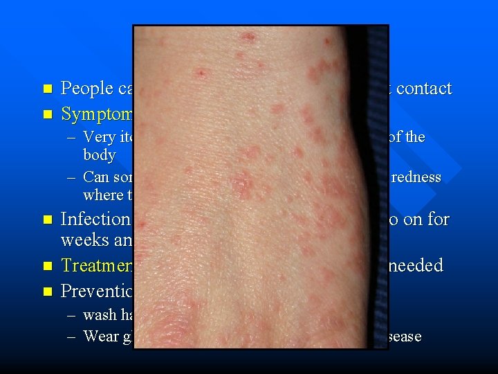 Scabies n n People can get scabies from dogs by direct contact Symptoms: –