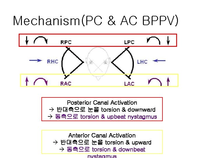 Mechanism(PC & AC BPPV) Posterior Canal Activation à 반대측으로 눈을 torsion & downward à