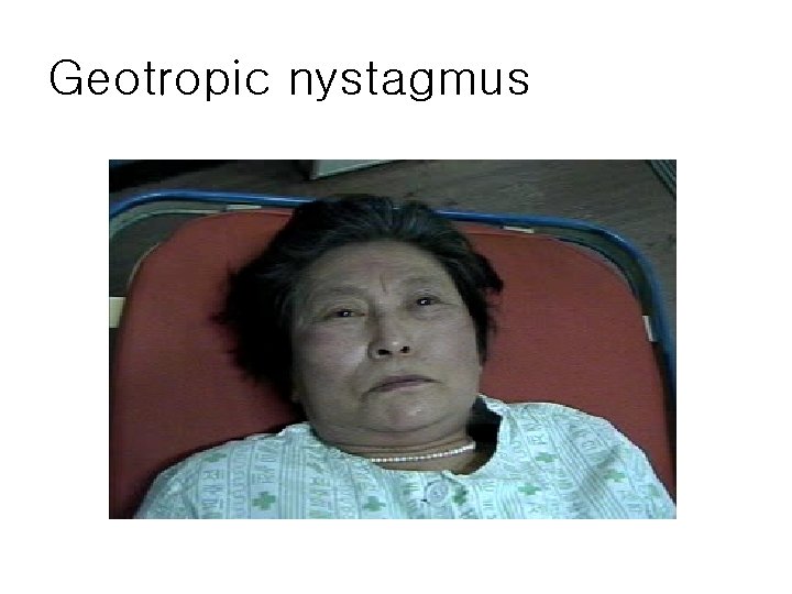 Geotropic nystagmus 