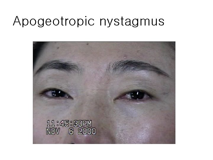 Apogeotropic nystagmus 