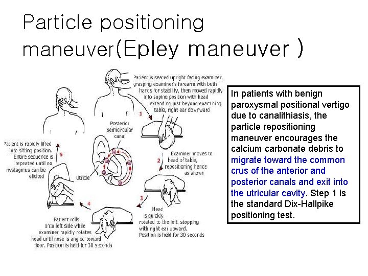 Particle positioning maneuver(Epley maneuver ) In patients with benign paroxysmal positional vertigo due to