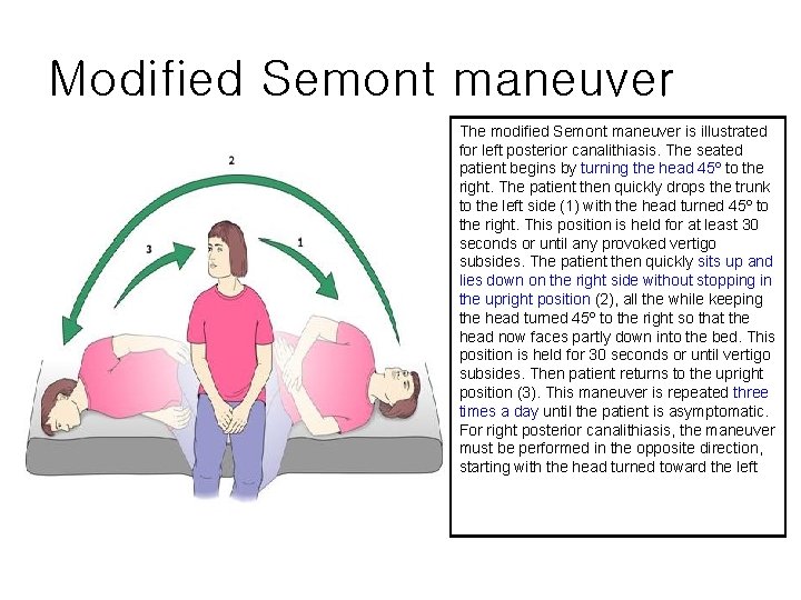 Modified Semont maneuver The modified Semont maneuver is illustrated for left posterior canalithiasis. The