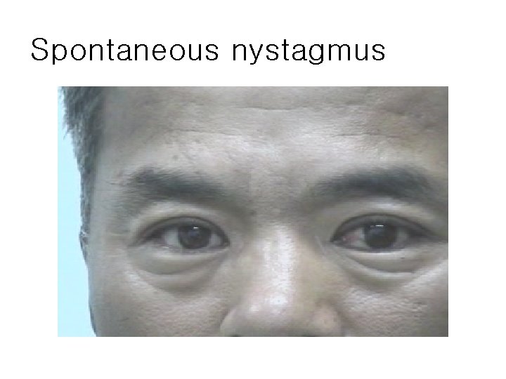 Spontaneous nystagmus 