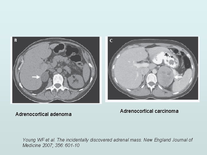 Adrenocortical adenoma Adrenocortical carcinoma Young WF et al. The incidentally discovered adrenal mass. New