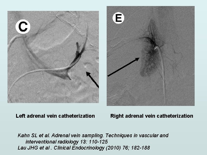 Left adrenal vein catheterization Right adrenal vein catheterization Kahn SL et al. Adrenal vein