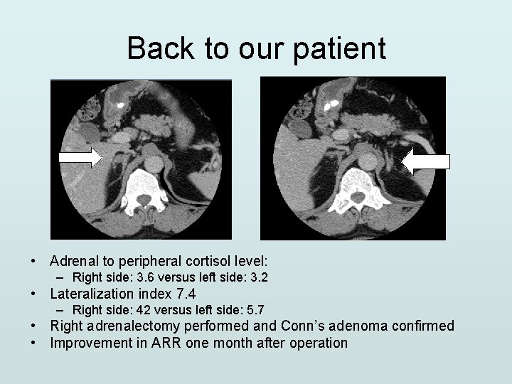 Back to our patient • Adrenal to peripheral cortisol level: – Right side: 3.