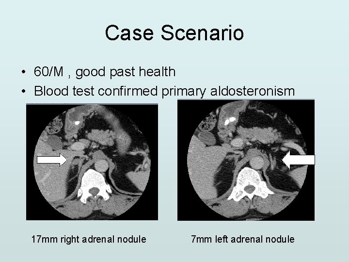 Case Scenario • 60/M , good past health • Blood test confirmed primary aldosteronism
