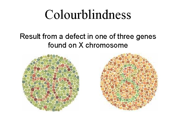 Colourblindness Result from a defect in one of three genes found on X chromosome