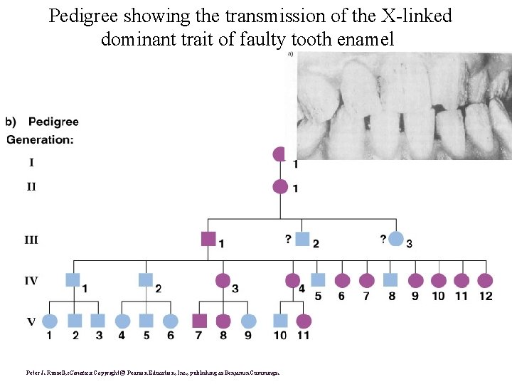 Pedigree showing the transmission of the X-linked dominant trait of faulty tooth enamel Peter
