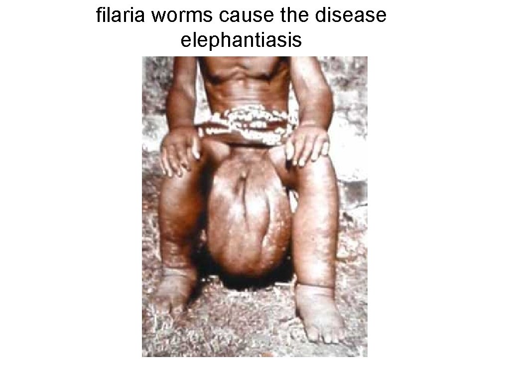 filaria worms cause the disease elephantiasis 