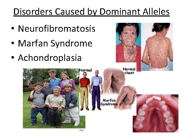 Disorders Caused by Dominant Alleles • Neurofibromatosis • Marfan Syndrome • Achondroplasia 