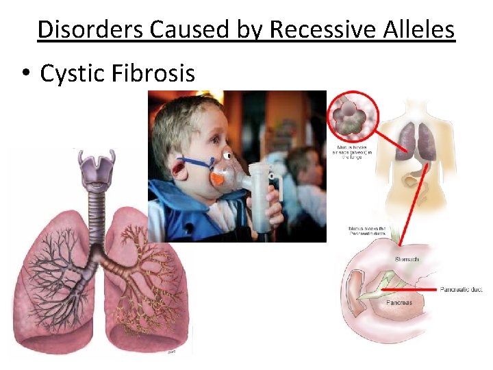 Disorders Caused by Recessive Alleles • Cystic Fibrosis 