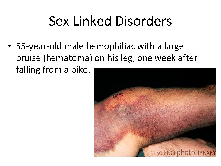 Sex Linked Disorders • 55 -year-old male hemophiliac with a large bruise (hematoma) on