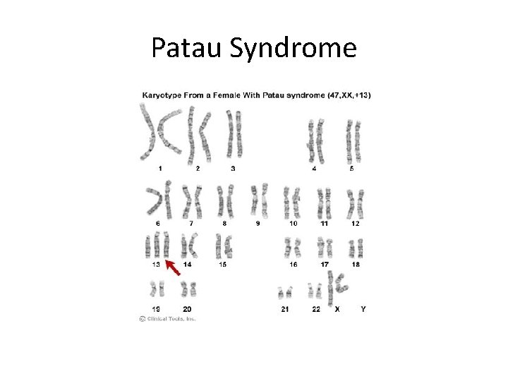 Patau Syndrome 