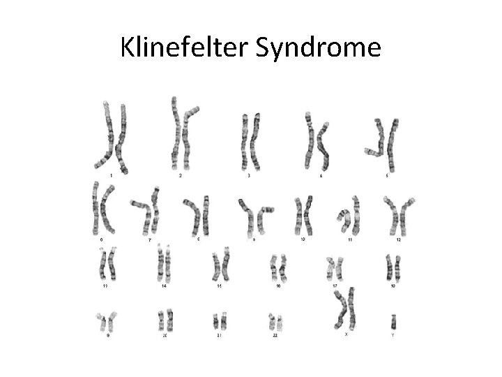 Klinefelter Syndrome 