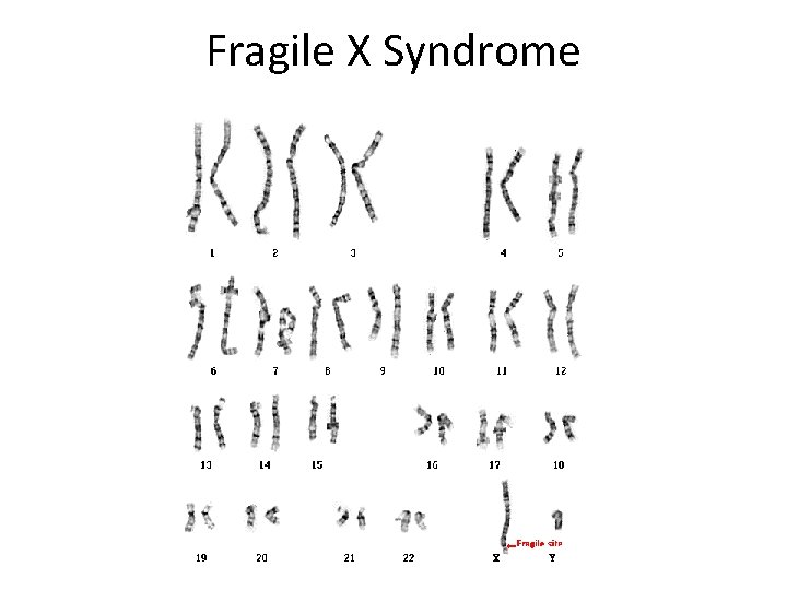 Fragile X Syndrome 