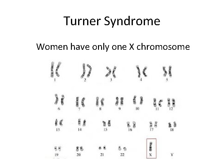 Turner Syndrome Women have only one X chromosome 