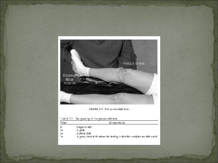 Acl Tear Dr Naif S Alaffari S V